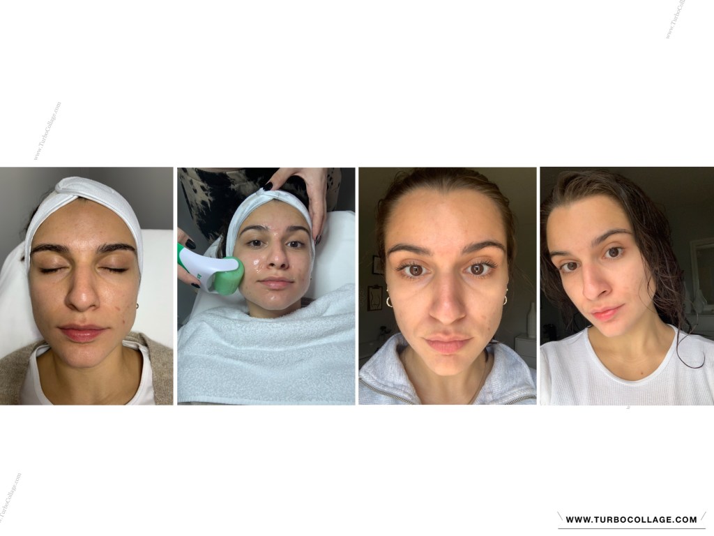MY CHEMICAL PEEL EXPERIENCE: PRO-CLEAR&nbsp;PEEL